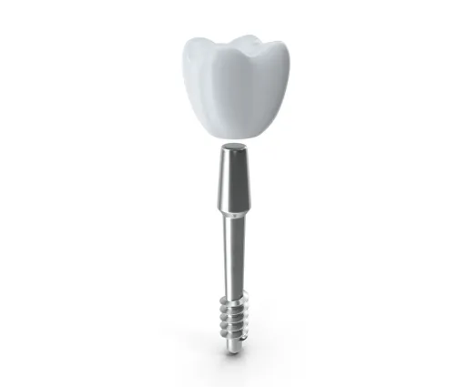 Tooth implants made with laser solutions of SLTL